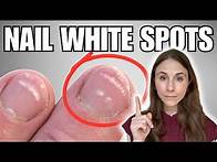 Video thumbnail for Why You Have White Spots On The Nails