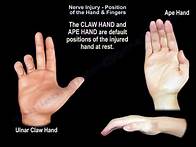 Video thumbnail for Nerve Injury Position of the Hand & Fingers - Everything You Need To Know - Dr. Nabil Ebraheim