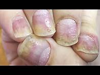 Video thumbnail for Home Remedies for Nail Psoriasis