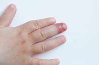 Video thumbnail for Paronychia - Skin Infection Around the Nails | familydoctor.org