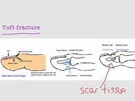 Video thumbnail for BoneTalks - FingerTip and Nailbed Injuries (Tuft Fracture)