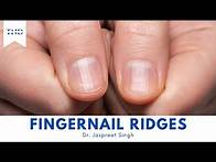 Video thumbnail for Do You Have Vertical Ridges On Your Fingernails? Here's What They Mean!