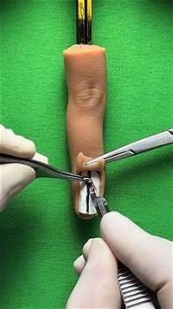 Video thumbnail for Nail Matrix Biopsy for Melanonychia: Procedure and Symptoms Explained