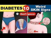Video thumbnail for Diabetes skin signs | Diabetes symptoms | Signs of Diabetes | Diabetes mellitus | Type 1 diabetes