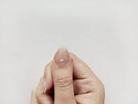 Video thumbnail for What Dermatologists Want You to Know About White Spots on Your Nails