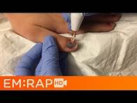 Video thumbnail for Trephination of a Fingernail Subungual Hematoma