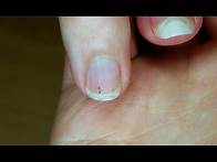 Video thumbnail for The Basics: How to Remove a Splinter | WebMD