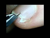 Video thumbnail for How to extract splinter from under fingernail
