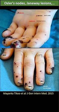 Video thumbnail for Osler Nodes, Janeway lesion, Roth spot, splinter hemorrhage
