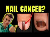 Video thumbnail for Cancer of the nail? Doctor O'Donovan explains Acral Lentiginous Melanoma and Subungual Melanoma