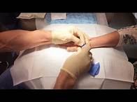 Video thumbnail for Ingrown Fingernail With Fungal Infection Removal - Dr. David Sawcer