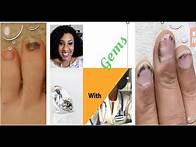 Video thumbnail for Nail Mysteries Unveiled: Exploring Splinter Hemorrhages, Beau's Lines, and Nail Psoriasis!"