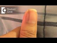 Video thumbnail for What causes vertical black lines on fingernails? - Dr. Aruna Prasad