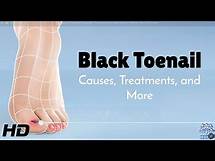 Video thumbnail for Black Toenail Problems? Learn Causes & Simple Solutions