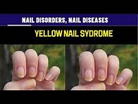 Video thumbnail for yellow nails syndrome |Onychogryphosis