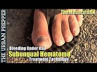 Video thumbnail for Blood Under Nail Treatment Technique featuring TheMountainRN