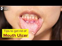 Video thumbnail for Mouth Ulcer| Mouth Sores: Symptoms, Treatment & Prevention Methods-Dr.Lahari A.S.R | Doctors' Circle