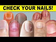 Video thumbnail for 9 Things Your Nails Can Tell You About Your Health