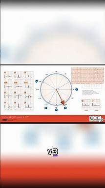 Video thumbnail for Mastering EKG Interpretation: Decoding a Normal R-Wave Progression
