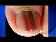 Video thumbnail for Doctors Warn Of Potentiall Deadly Form Of Nail Cancer