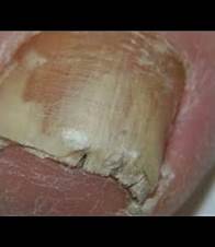 Video thumbnail for Onychonil Nail Paint (for nail fungal infection "onychomycosis")