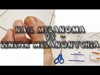Video thumbnail for Nail Melanoma VS Melanonychia - learn from my story