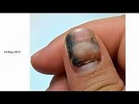 Video thumbnail for Subungual Hematoma Time Lapse
