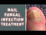 Video thumbnail for HOW TO TREAT FUNGAL NAIL INFECTION - TINEA UNGUIUM / ONYCHOMYCOSIS