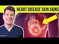 Video thumbnail for 12 SKIN and NAIL signs of HEART DISEASE