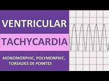 Video thumbnail for Ventricular Tachycardia (V-tach) ECG Interpretation, Treatment, Nursing NCLEX Review