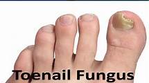 Video thumbnail for Most Common Toenail Problems - Home Treatment Guide!