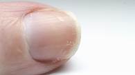 Video thumbnail for What the white marks on your fingernails mean