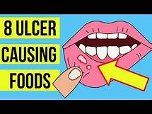 Video thumbnail for 8 FOODS and DRINKS causing MOUTH ULCERS (Canker sore) | Plus treatment