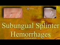 Video thumbnail for Subungual Splinter Hemorrhages. Bacterial Endocarditis.