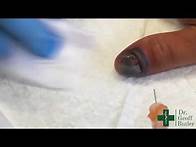 Video thumbnail for Drainage of a Subungual Hematoma using Burr holes