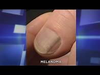 Video thumbnail for Subungual Melanoma: What You Need to Know