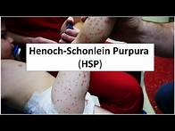 Video thumbnail for Henoch-Schonlein Purpura (HSP)