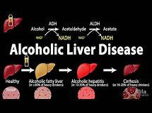 Video thumbnail for Alcoholic Liver Disease, Animation