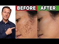 Video thumbnail for How to Get Rid of Hyperpigmentation (Aging or Dark Spots)