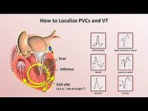 Video thumbnail for Advanced EKGs - Ventricular Tachycardia (Classification & Localization)