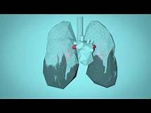 Video thumbnail for WHO: Breathe Life - How air pollution impacts your body