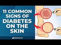 Video thumbnail for 11 Common Signs of Diabetes on The Skin