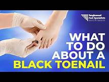Video thumbnail for What to do About a Black Toenail