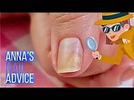 Video thumbnail for Nail Separation | Causes | Early Treatment of Onycholysis [Anna's Nail Advice]