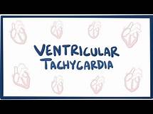 Video thumbnail for Ventricular tachycardia (VT) - causes, symptoms, diagnosis, treatment & pathology