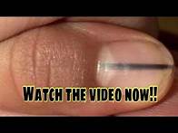 Video thumbnail for A black line on your nails could be a sign of cancer!! Did you know?