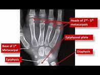 Video thumbnail for Age Estimation From Wrist X-ray