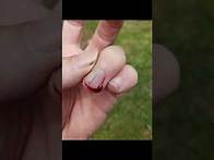 Video thumbnail for Emergency First Aid : Removing a splinter from under a fingernail.