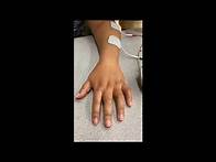 Video thumbnail for Electrical Stimulation for Stroke Survivors: Fingers