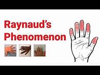 Video thumbnail for Raynaud’s Phenomenon : What You Should Know | Johns Hopkins Medicine